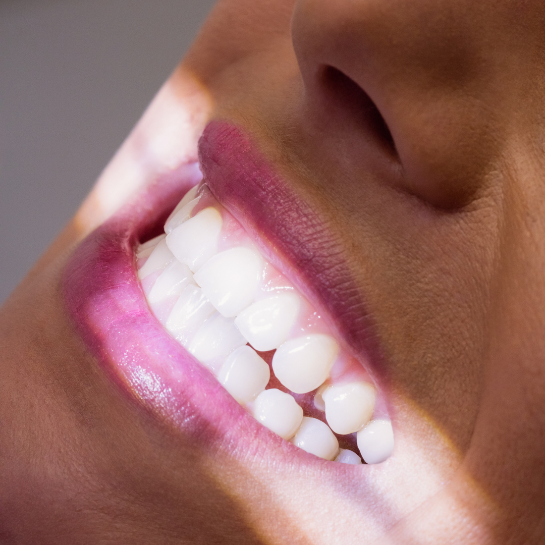 Unwanted Tooth Movement: Why Your Smile Might Not Stay Put