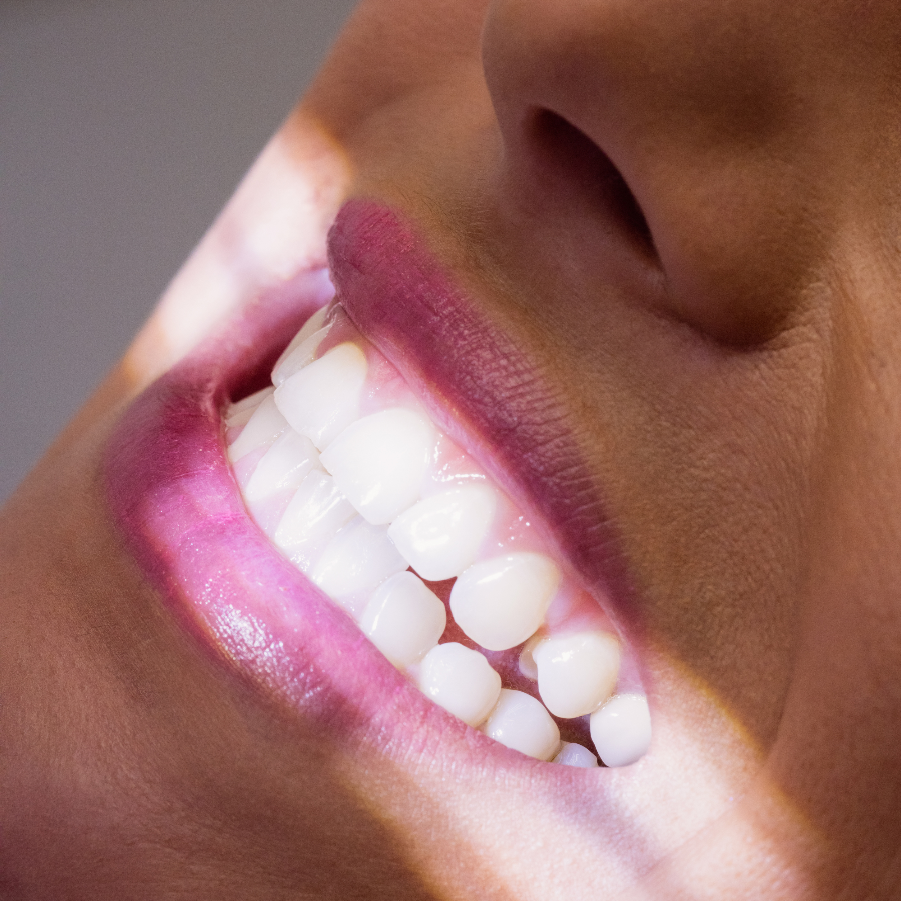 Unwanted Tooth Movement: Why Your Smile Might Not Stay Put