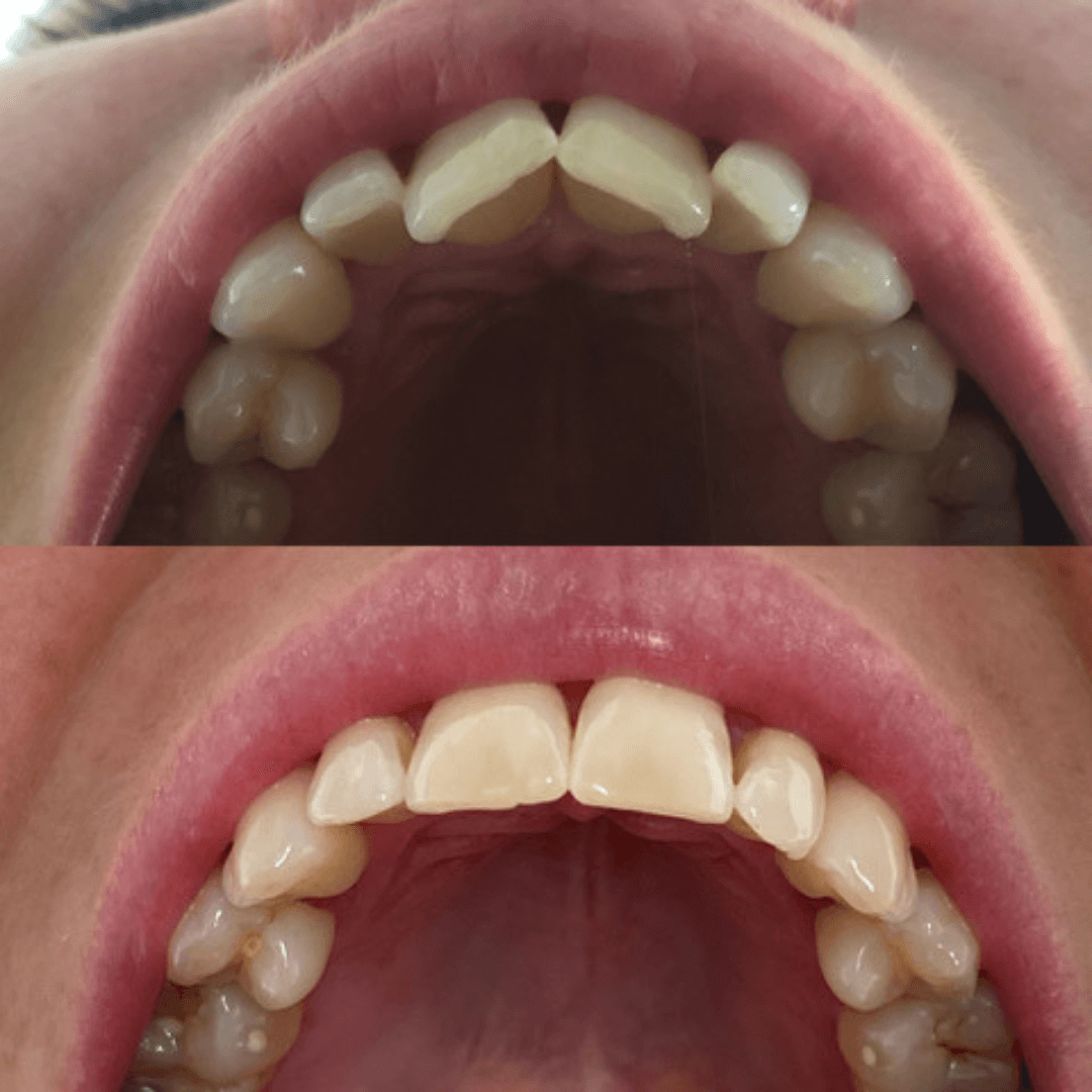 Retainers (upper and lower)