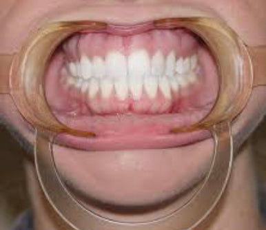 Refinement Aligners